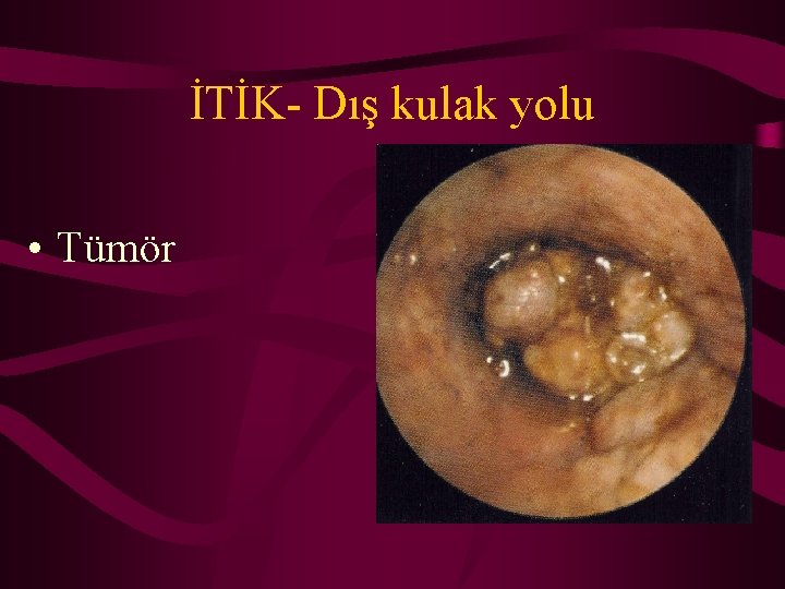 İTİK- Dış kulak yolu • Tümör 