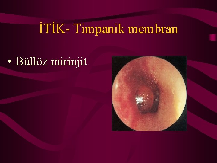 İTİK- Timpanik membran • Büllöz mirinjit 