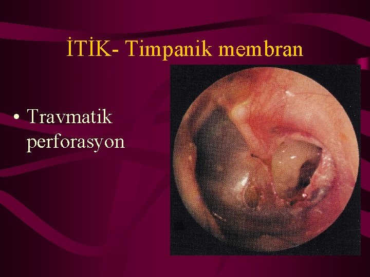 İTİK- Timpanik membran • Travmatik perforasyon 