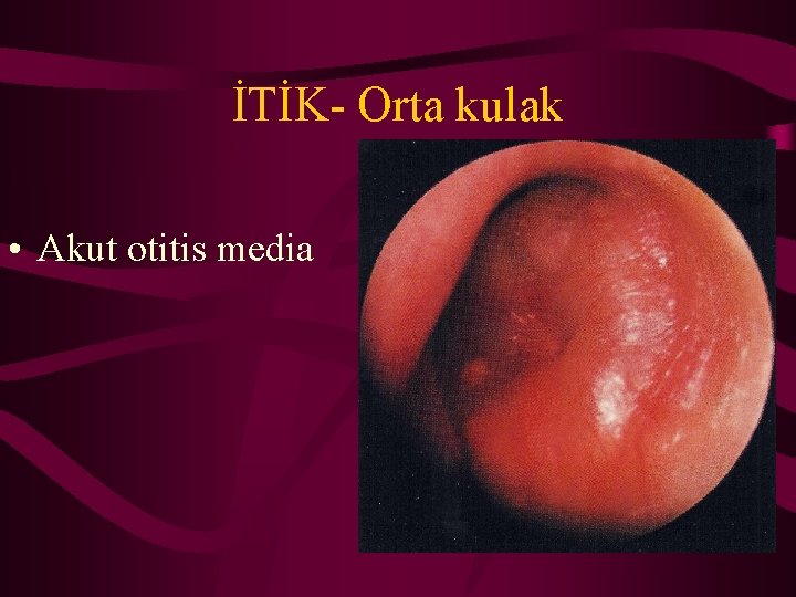 İTİK- Orta kulak • Akut otitis media 