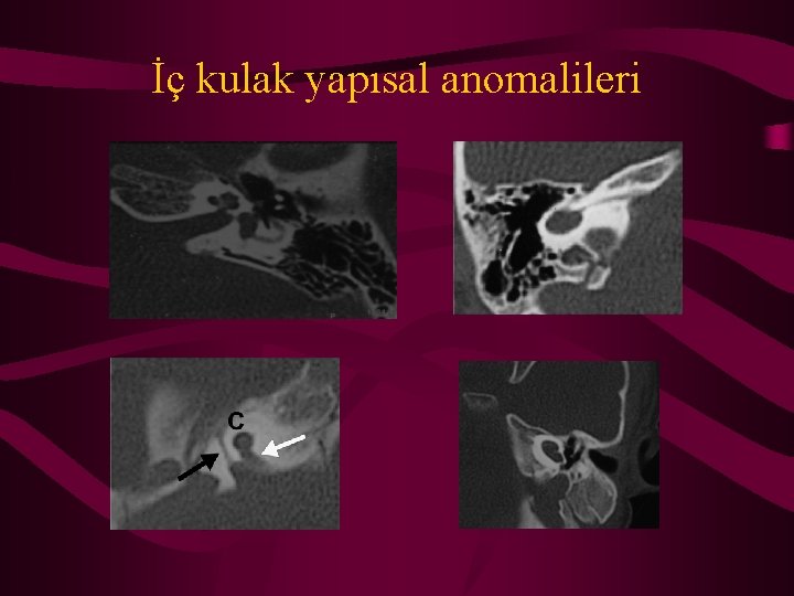 İç kulak yapısal anomalileri 