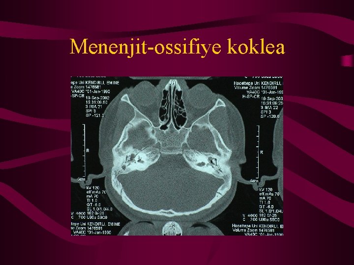 Menenjit-ossifiye koklea 