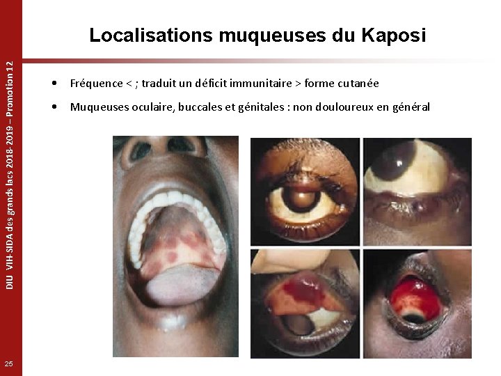 DIU VIH-SIDA des grands lacs 2018 -2019 – Promotion 12 Localisations muqueuses du Kaposi