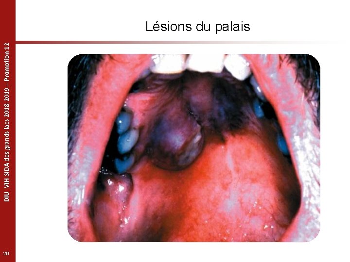 DIU VIH-SIDA des grands lacs 2018 -2019 – Promotion 12 Lésions du palais 26
