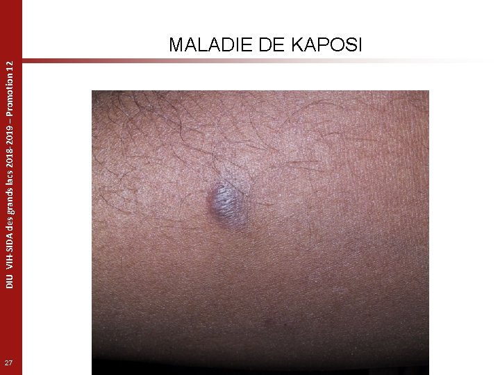DIU VIH-SIDA des grands lacs 2018 -2019 – Promotion 12 MALADIE DE KAPOSI 27