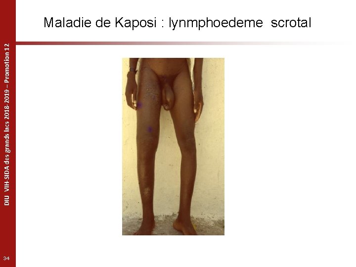 DIU VIH-SIDA des grands lacs 2018 -2019 – Promotion 12 Maladie de Kaposi :