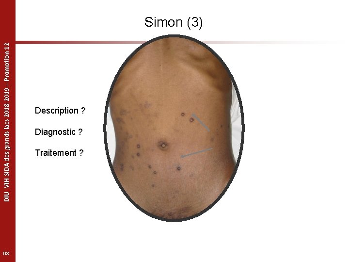 DIU VIH-SIDA des grands lacs 2018 -2019 – Promotion 12 Simon (3) 68 Description