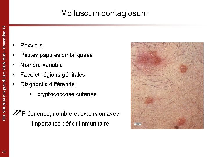 DIU VIH-SIDA des grands lacs 2018 -2019 – Promotion 12 Molluscum contagiosum 70 •