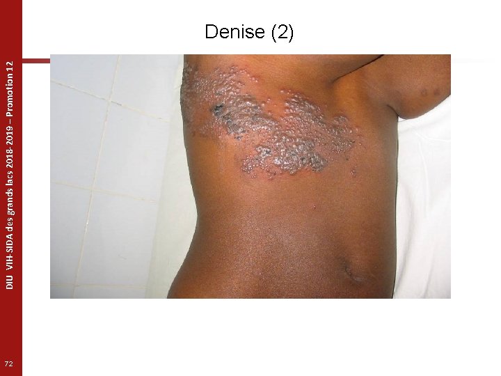 DIU VIH-SIDA des grands lacs 2018 -2019 – Promotion 12 Denise (2) 72 