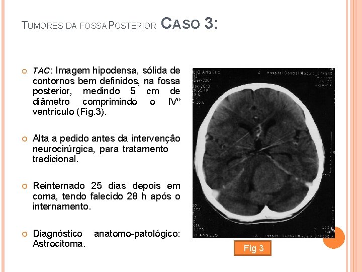 CASO 3: TUMORES DA FOSSA POSTERIOR TAC: Imagem hipodensa, sólida de contornos bem definidos,