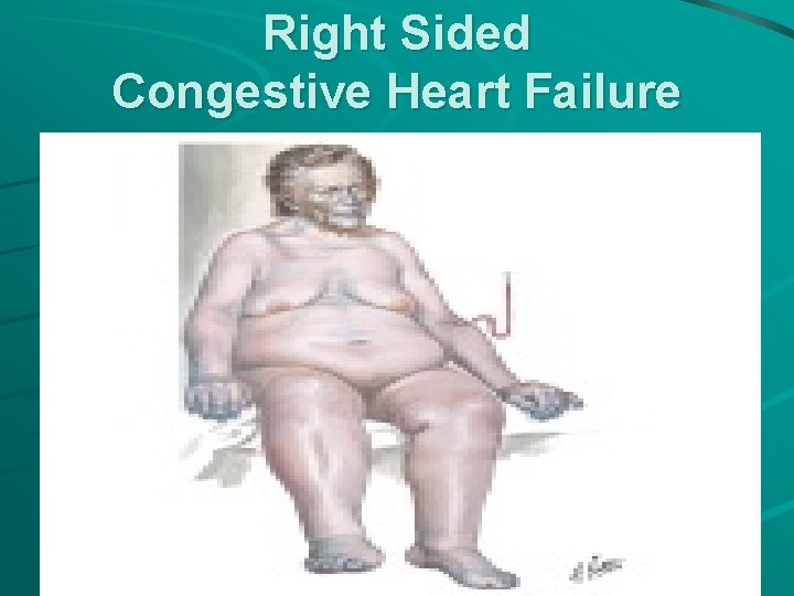 Right Sided Congestive Heart Failure 