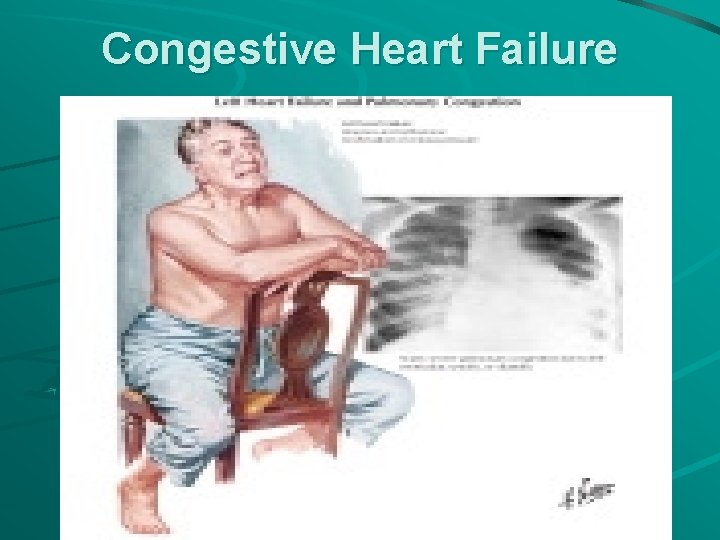 Congestive Heart Failure 