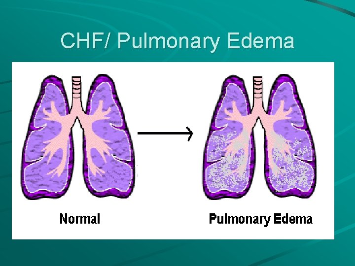 CHF/ Pulmonary Edema 