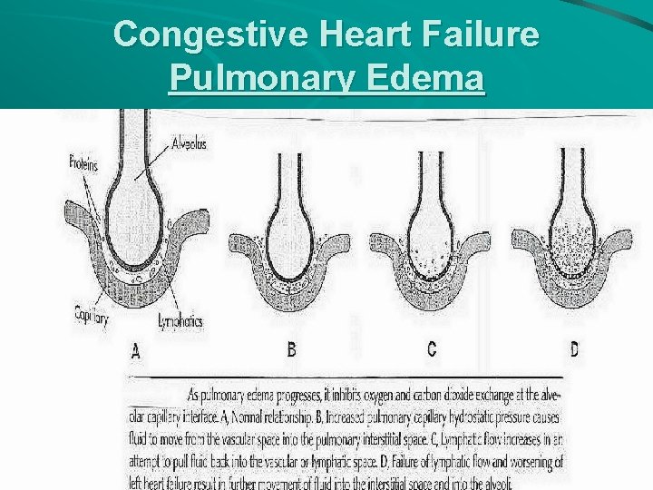 Congestive Heart Failure Pulmonary Edema 