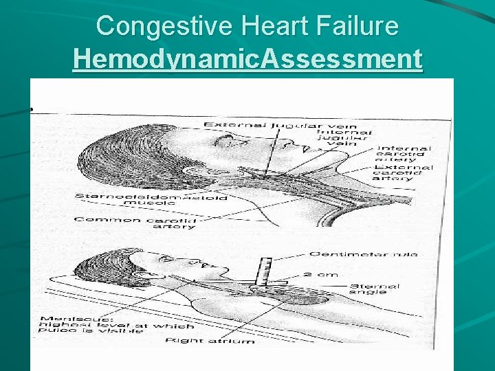 Congestive Heart Failure Hemodynamic. Assessment 