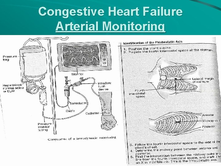 Congestive Heart Failure Arterial Monitoring 