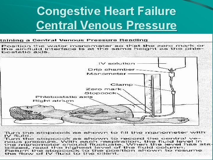 Congestive Heart Failure Central Venous Pressure 