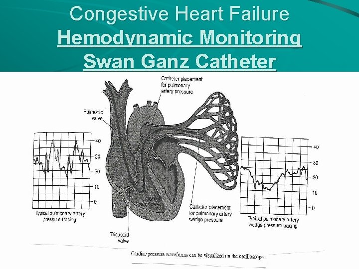 Congestive Heart Failure Hemodynamic Monitoring Swan Ganz Catheter 