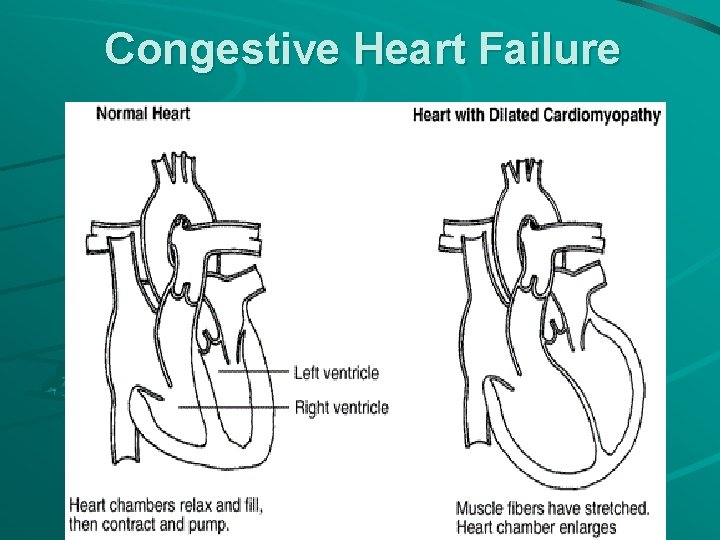 Congestive Heart Failure 