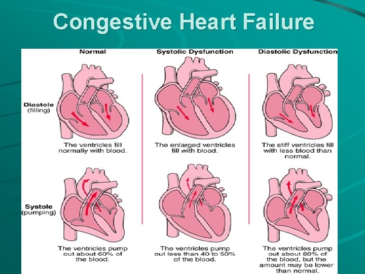 Congestive Heart Failure 