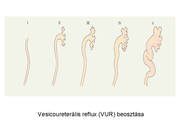 Vesicoureterális reflux (VUR) beosztása 