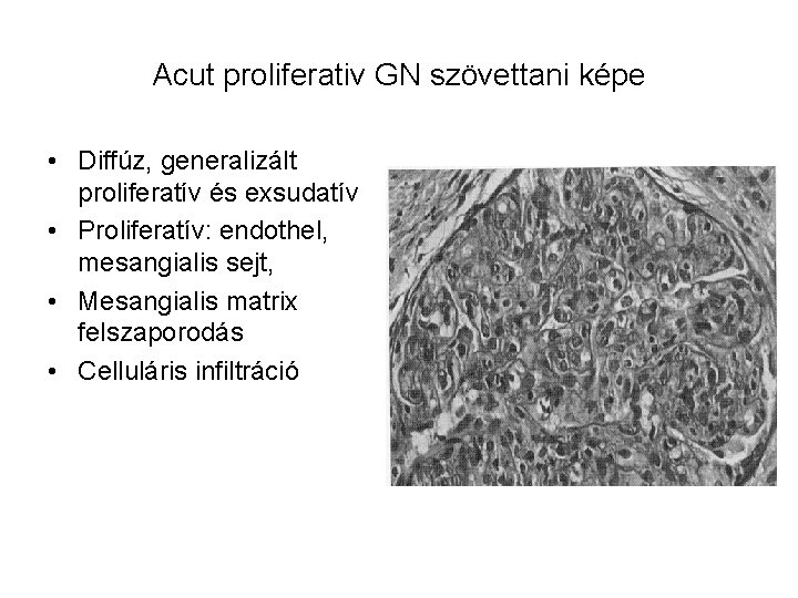 Acut proliferativ GN szövettani képe • Diffúz, generalizált proliferatív és exsudatív • Proliferatív: endothel,