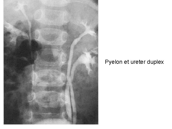 Pyelon et ureter duplex 