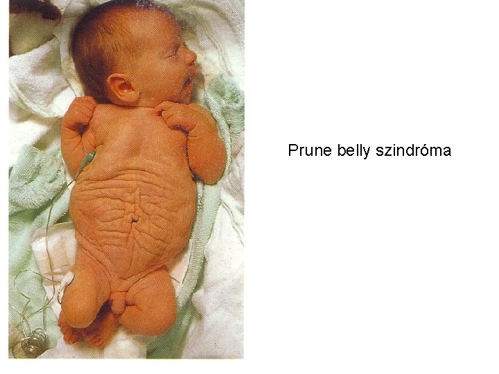 Prune belly szindróma 