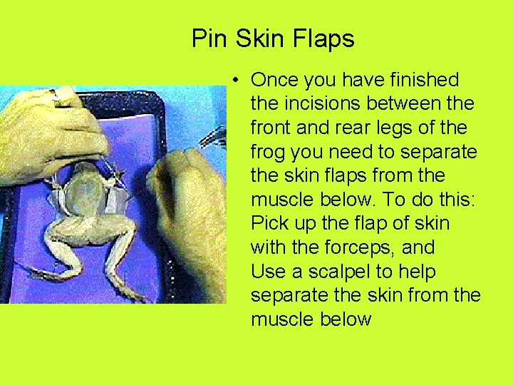 Pin Skin Flaps • Once you have finished the incisions between the front and