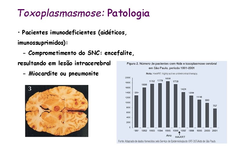 Toxoplasmasmose: Patologia • Pacientes imunodeficientes (aidéticos, imunossuprimidos): - Comprometimento do SNC: encefalite, resultando em