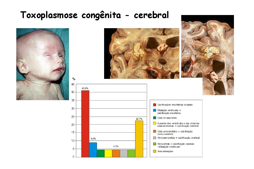 Toxoplasmose congênita - cerebral 