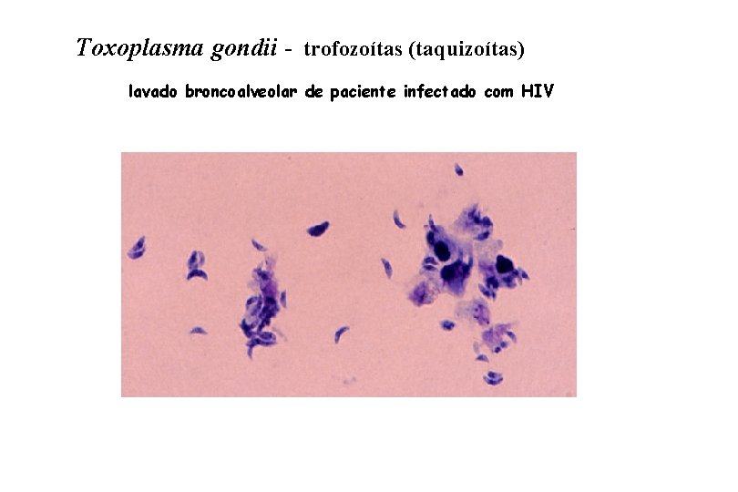 Toxoplasma gondii - trofozoítas (taquizoítas) lavado broncoalveolar de paciente infectado com HIV 