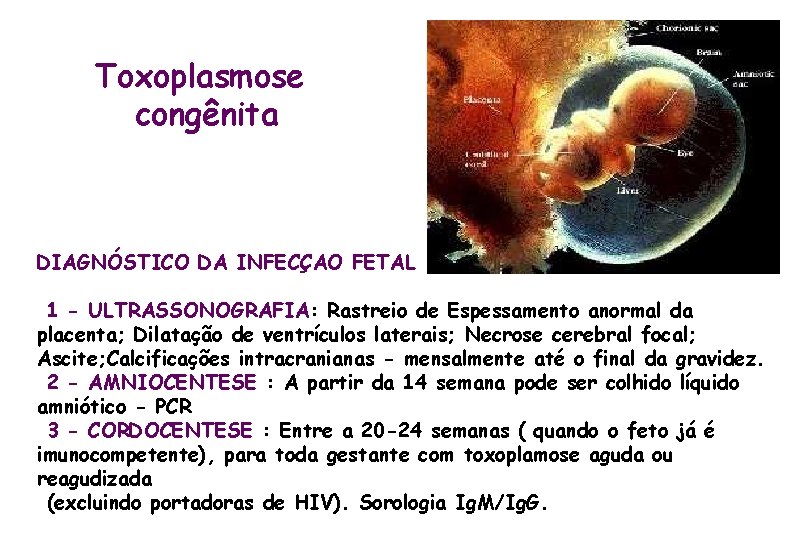 Toxoplasmose congênita DIAGNÓSTICO DA INFECÇAO FETAL 1 - ULTRASSONOGRAFIA: Rastreio de Espessamento anormal da