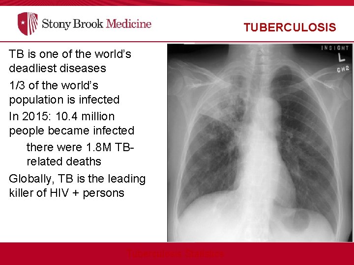 TUBERCULOSIS TB is one of the world’s deadliest diseases 1/3 of the world’s population