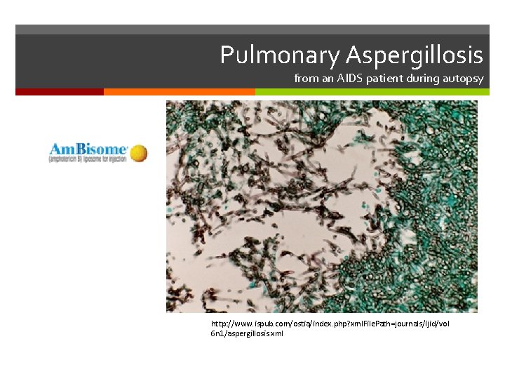 Pulmonary Aspergillosis from an AIDS patient during autopsy http: //www. ispub. com/ostia/index. php? xml.