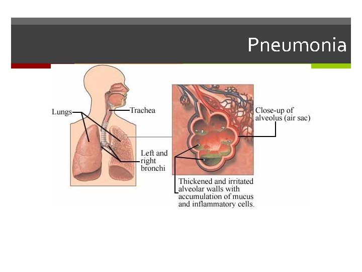 Pneumonia 