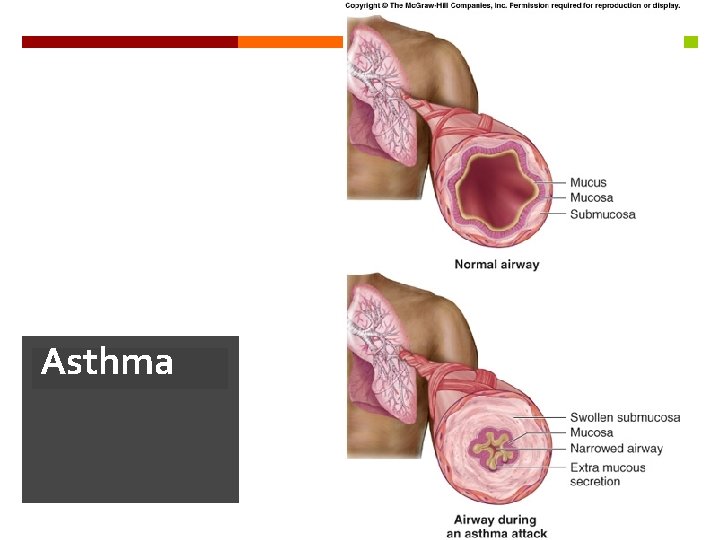 Asthma 