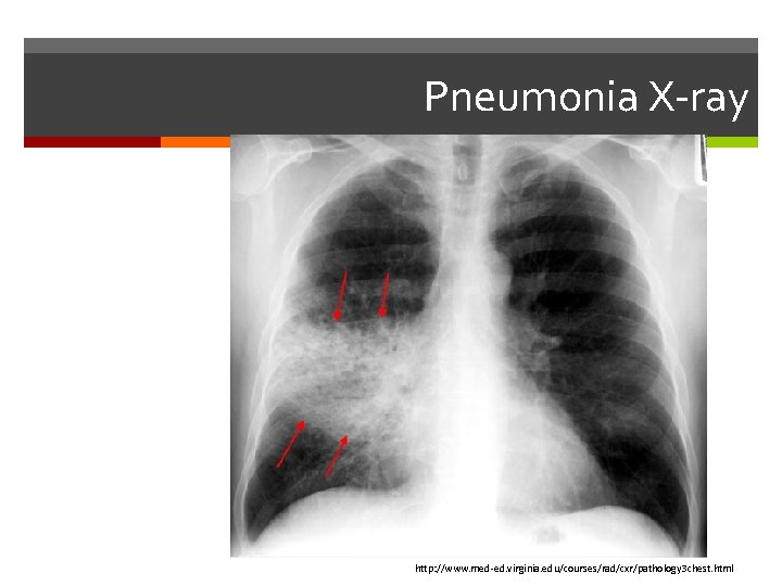 Pneumonia X-ray http: //www. med-ed. virginia. edu/courses/rad/cxr/pathology 3 chest. html 