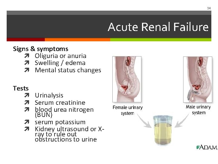 34 Acute Renal Failure Signs & symptoms Oliguria or anuria Swelling / edema Mental