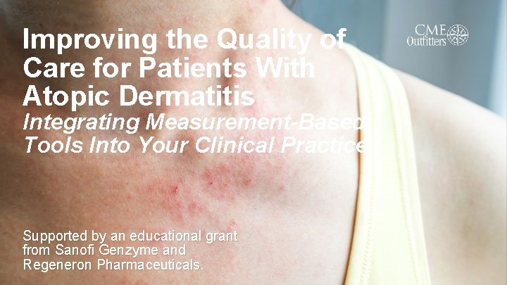 Improving the Quality of Care for Patients With Atopic Dermatitis Integrating Measurement-Based Tools Into