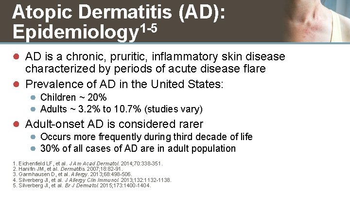 Atopic Dermatitis (AD): Epidemiology 1 -5 ● AD is a chronic, pruritic, inflammatory skin