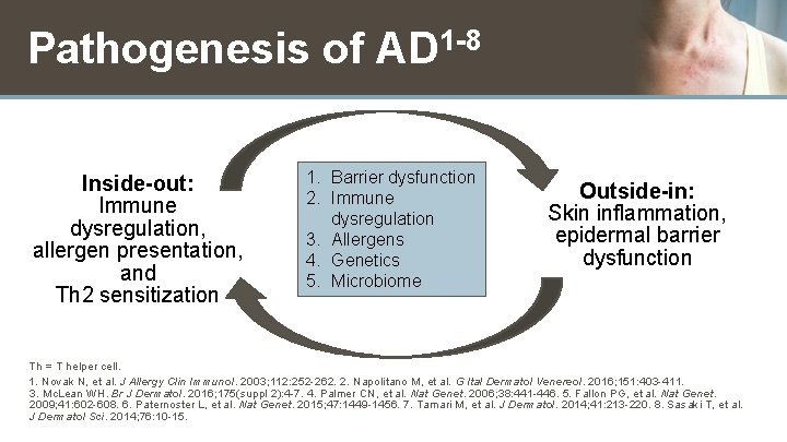 Pathogenesis of AD 1 -8 Inside-out: Immune dysregulation, allergen presentation, and Th 2 sensitization