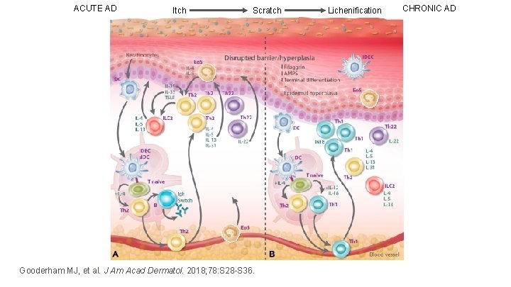 ACUTE AD Itch Scratch Gooderham MJ, et al. J Am Acad Dermatol. 2018; 78: