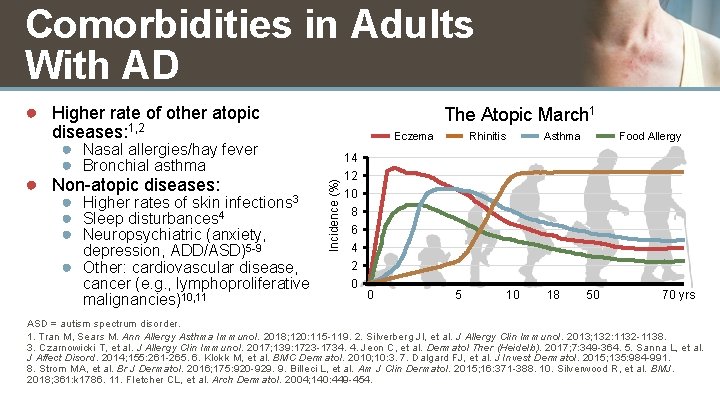 Comorbidities in Adults With AD ● Higher rate of other atopic depression, ADD/ASD)5 -9