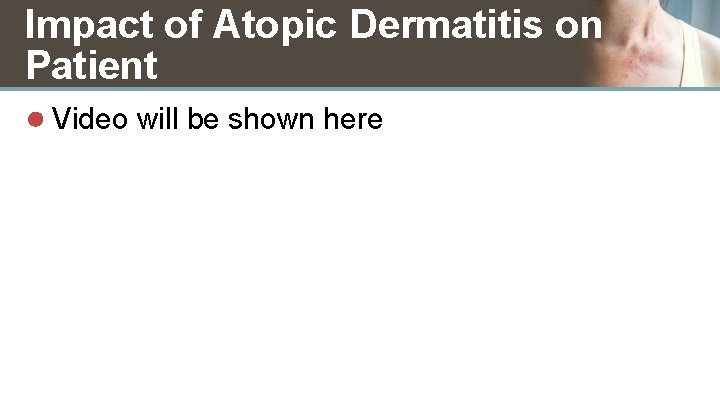 Impact of Atopic Dermatitis on Patient ● Video will be shown here 