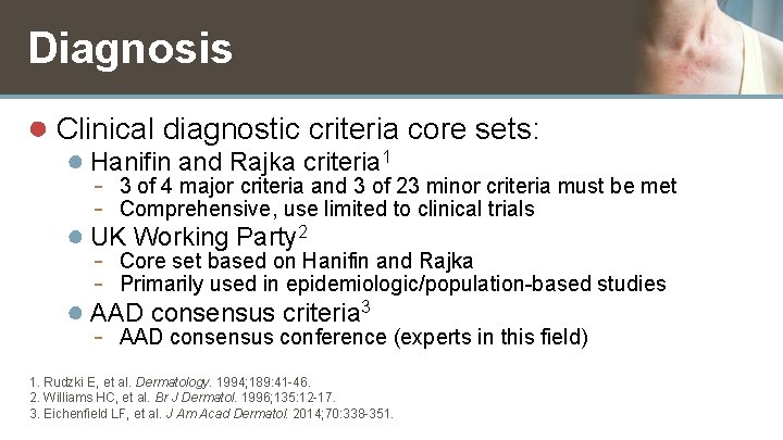 Diagnosis ● Clinical diagnostic criteria core sets: ● Hanifin and Rajka criteria 1 -