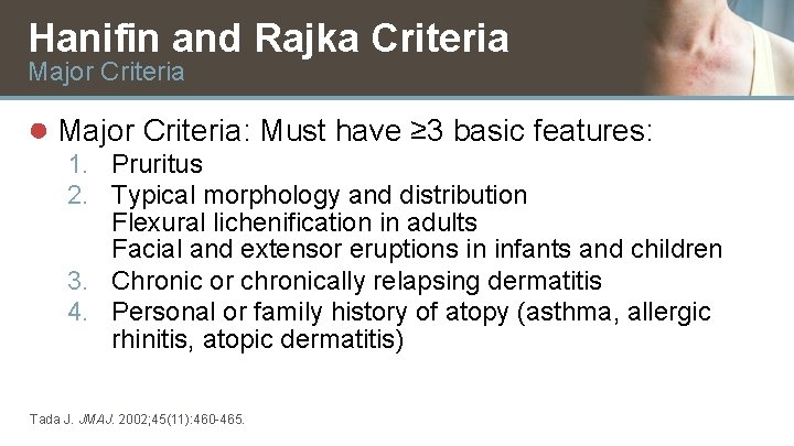 Hanifin and Rajka Criteria Major Criteria ● Major Criteria: Must have ≥ 3 basic