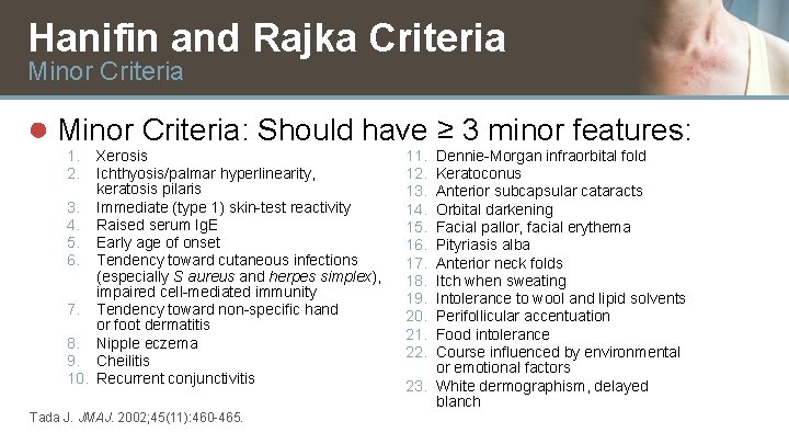 Hanifin and Rajka Criteria Minor Criteria ● Minor Criteria: Should have ≥ 3 minor