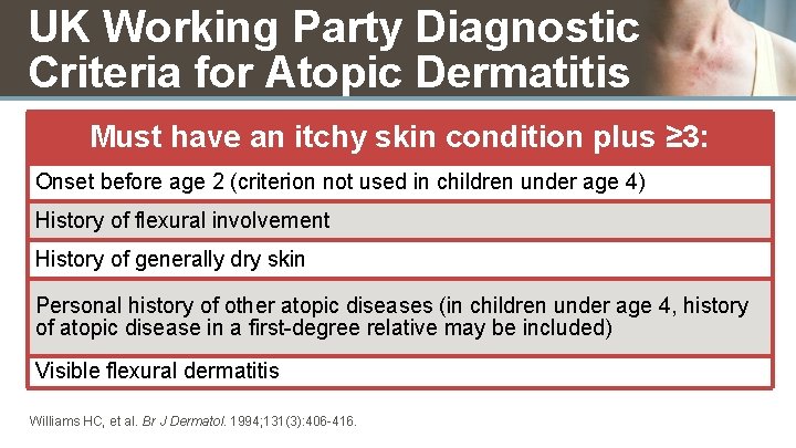 atopic dermatitis diagnosis criteria
