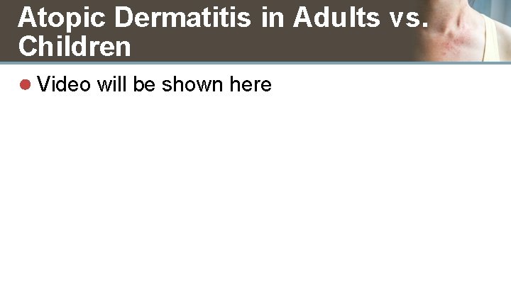 Atopic Dermatitis in Adults vs. Children ● Video will be shown here 